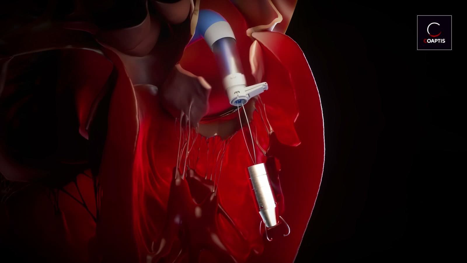 Coaptis device and delivery system illustrated inside a cutaway heart, from the device deployment animation.